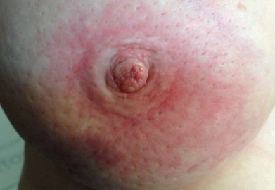 Meme kanseri belirtileri nelerdir? Nasıl anlaşılır?