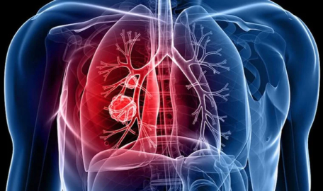 DSÖ açıkladı: Covid-19 pandemisi verem ölümlerini arttırdı