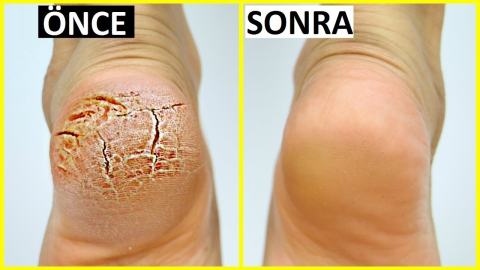 Topuk çatlağı nasıl geçer?