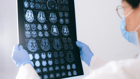 Alzheimer hastalarında beyin hücrelerinin neden öldüğü keşfedildi