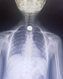 Bursa'da 7 yaşındaki çocuk madeni para yuttu: Madeni para röntgende görüntülendi