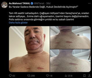 Polis şiddetine uğradığını söyleyen CHP’li Tanal, vücudundaki darp izlerini gösterdi