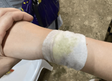 Bursa'da hıdırellez şenliğinde meşale kıvılcımları çocukları yaraladı