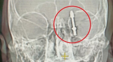 Bursa'da beynine saplanan implant hayatını kararttı!