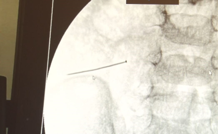 2 yaşındaki çocuk karın ağrısıyla hastaneye gitti, bağırsağından 3 santimlik iğne çıktı