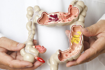 50 yaş üzeri risk altında: Kolon kanserine dikkat